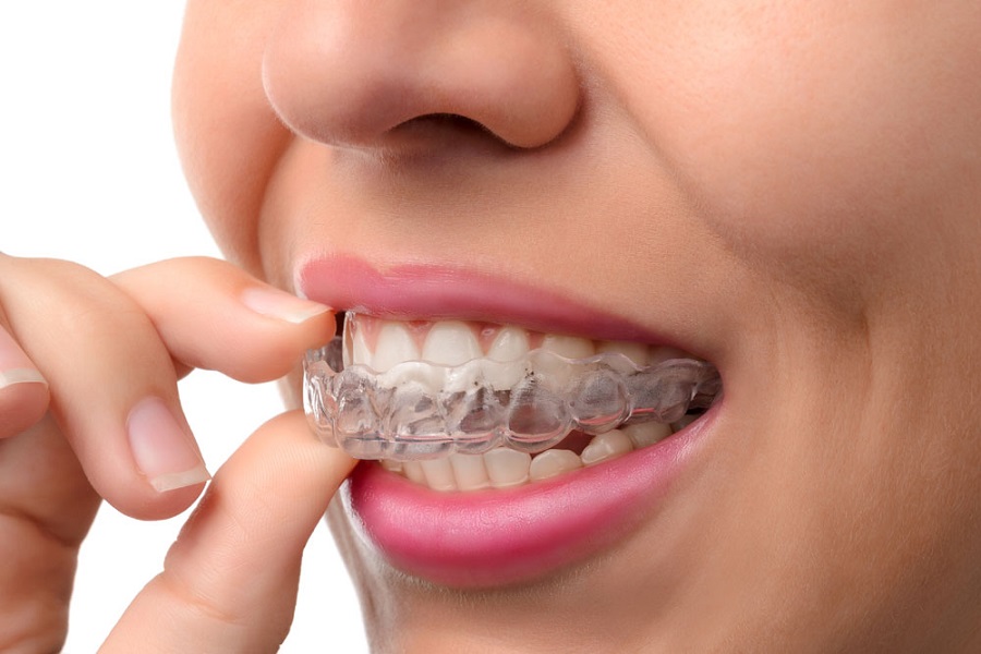 Scopri di più sull'articolo Far conoscere un apparecchio per denti con l’SMS Advertising: si può!
